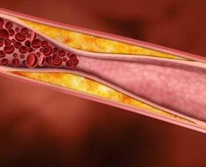 Cholesterol builds up inside the walls of our arteries. Overtime, arteries can hardened or narrowed to a degree of decreased blood flow and clot formation, or worse yet...they can become blocked completely.